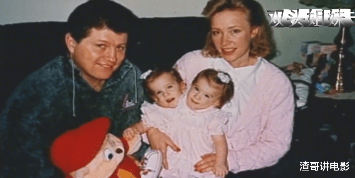 中国科学院|世界上真实存在的双头人，姐妹共用一个身体，却分别控制半边身体