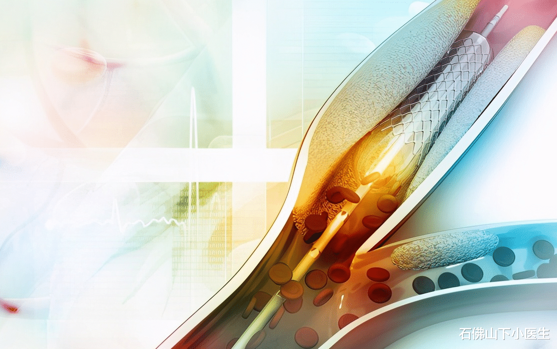 石佛山下小医生|药物球囊——冠心病治疗新方法，不用植入支架，能否完全取代支架