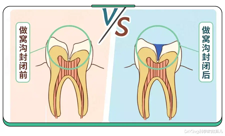 DrKing科学家庭育儿|5岁儿童蛀牙率70%！别只“控糖”了，这件事更要紧！