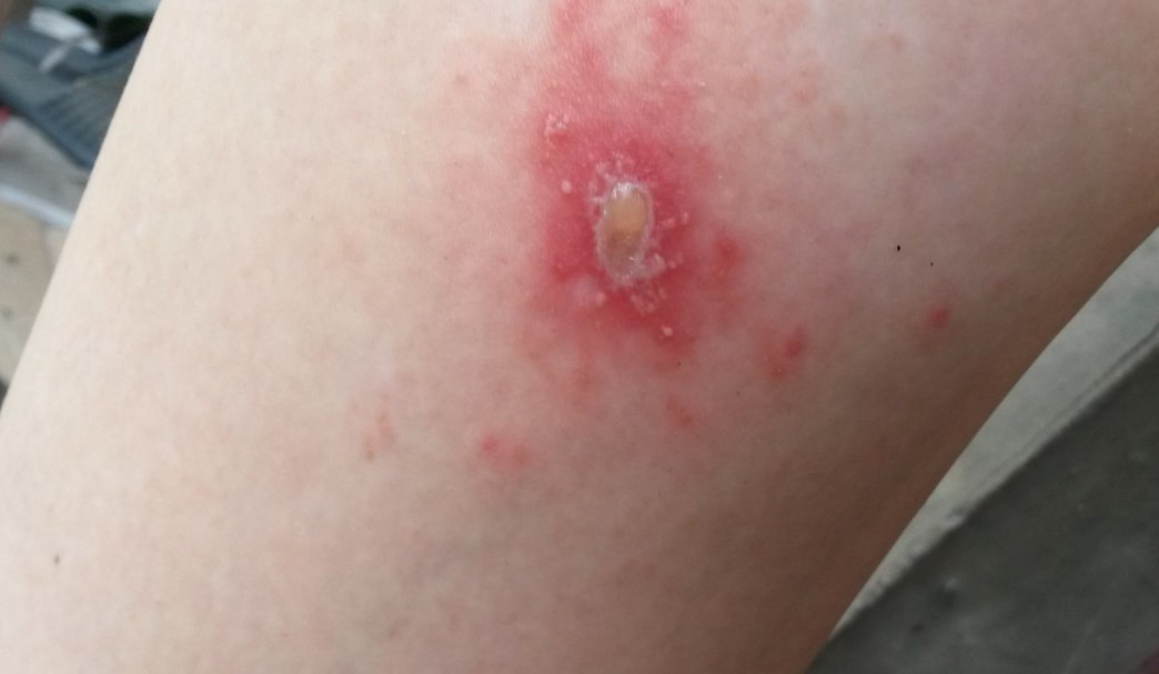 菁妈育儿|隐翅虫飞在孩子脸上,妈妈一吹一洗一擦救了娃,医生:教科书级别