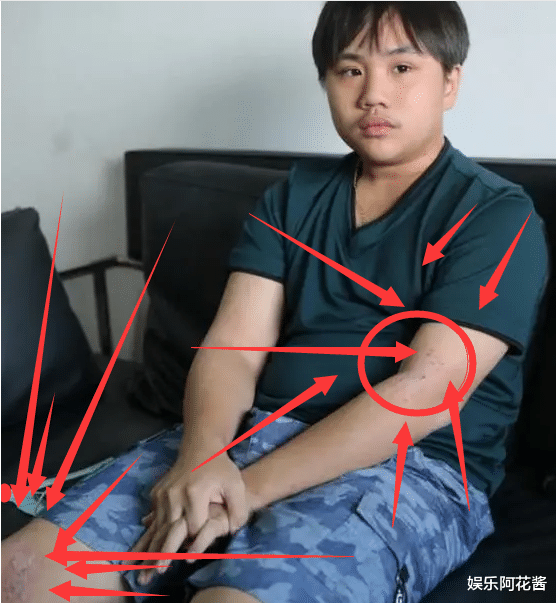 司藤|小小彬正当红时赚1800万，长残后无戏可拍，如今得病皮肤溃烂