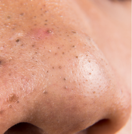 黑头|要不要买清洁泥膜?每周1次清洁泥膜,能帮你去黑头吗?答案在这!