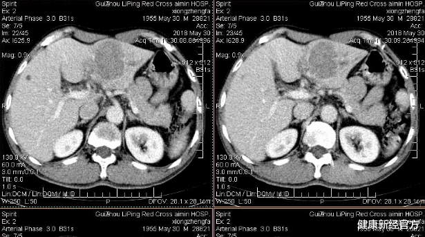 健康新经官方 26岁女子频繁腹痛，查出肝癌，肝科医生：如厕2个异常，趁早检查