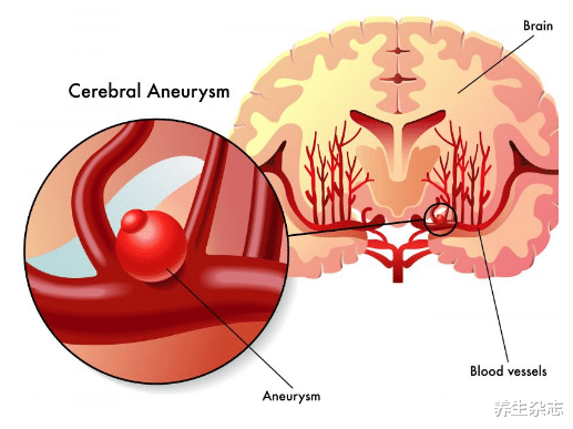 |48岁男子，每天“跑步”养血管，脑出血住院，医生咆哮：愚昧无知