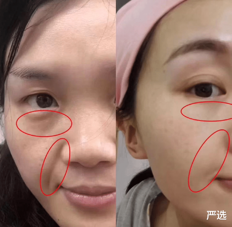 严选|河南女子花8000美白，两月后竟变“包公脸”？医生：难以恢复