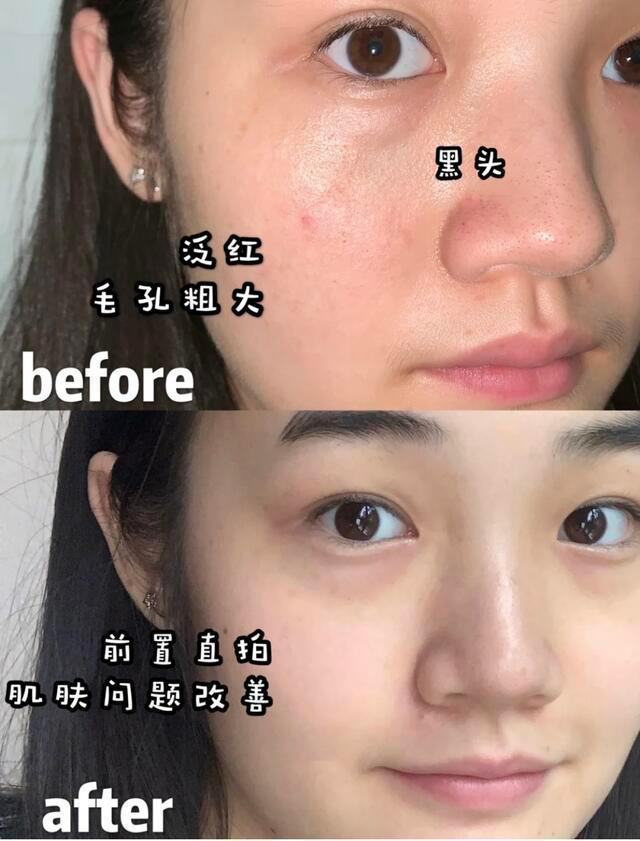 黑头 国内有一“低调”纯露，因便宜被嫌弃，用后黑头闭口渐渐消失