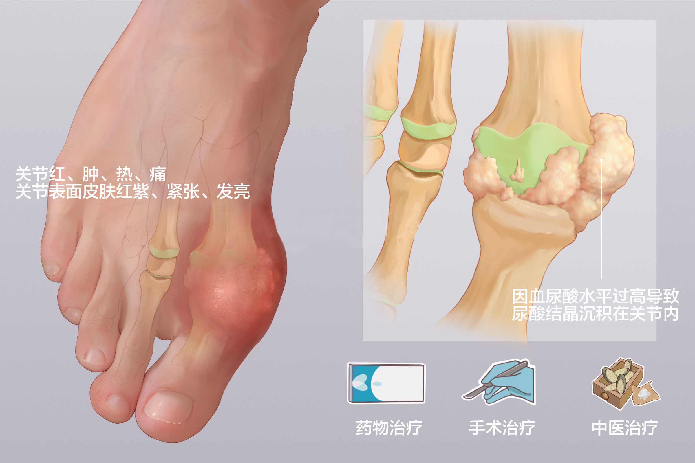 痛风|年轻人第一次犯痛风能否治愈?