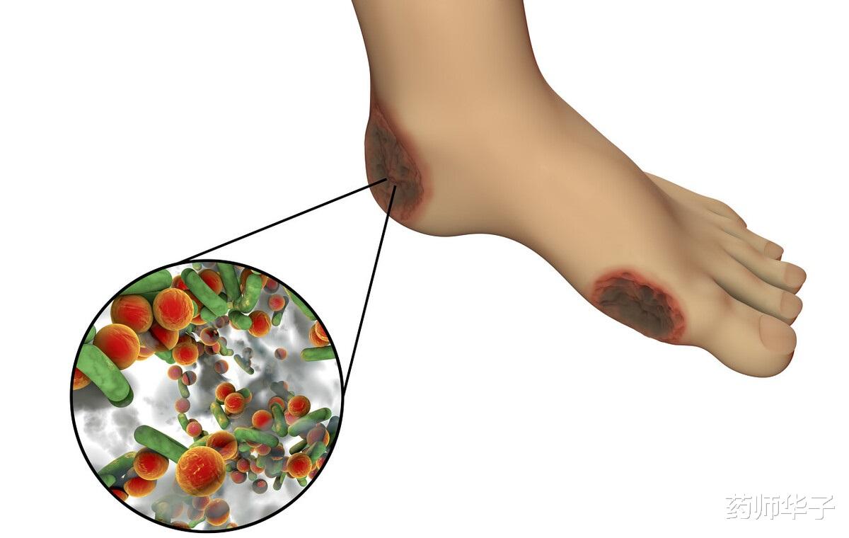 药师华子|为什么脚趾上的小伤会造成截肢？糖尿病足，预防比治疗更重要