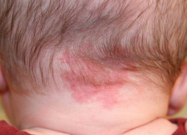 亚西亚健康网|宝宝的身上小血包，要分清是斑痣还是血管瘤