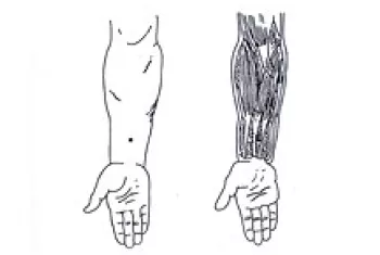 脑卒中|针灸穴位治疗各类痛证