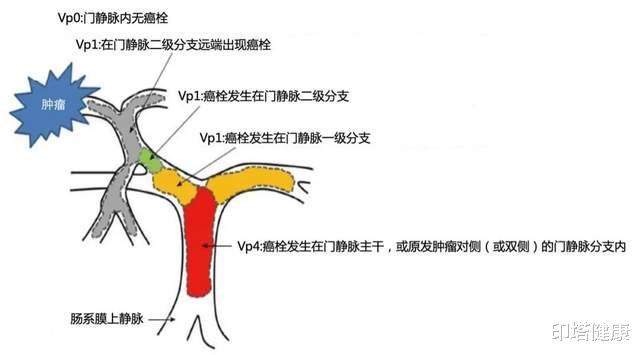 印塔健康|肝癌合并大血管侵犯：经碳离子放疗联合全身治疗（仑伐替尼）