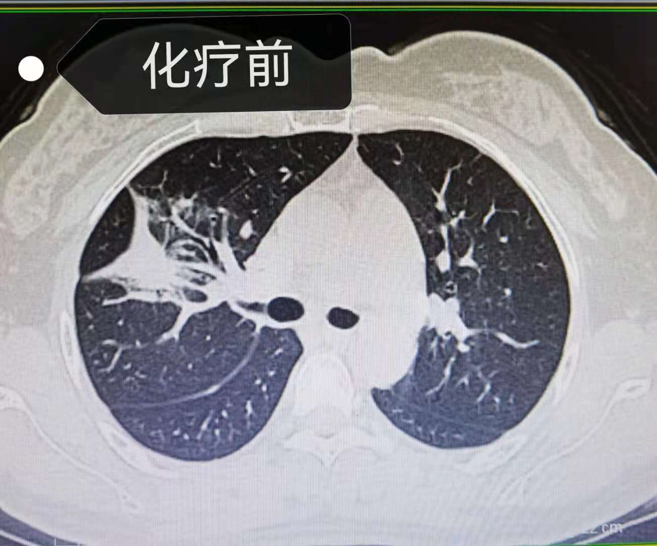 用户_胡洋|靶向耐药，45岁晚期肺癌病人使用化疗联合抗血管生成药物效果显著！