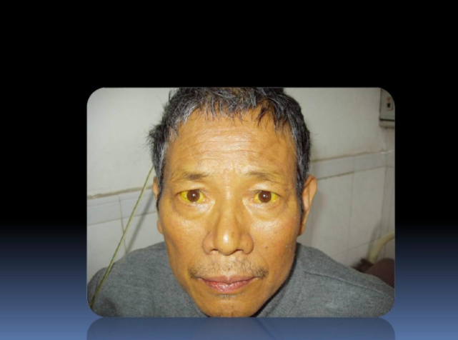 肝癌|老公一月25次“415”，女子查出肝癌，医生：有这样的老公，不得肝癌才怪