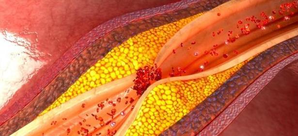 叶酸|酸奶、纯牛奶哪个更适合血脂高的人，听医生怎么说，不妨了解一下