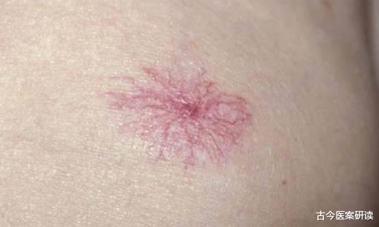 肝脏|经常吃鸡蛋会损害肝脏？医生：不想肝脏提前“报废”，这3物碰不得