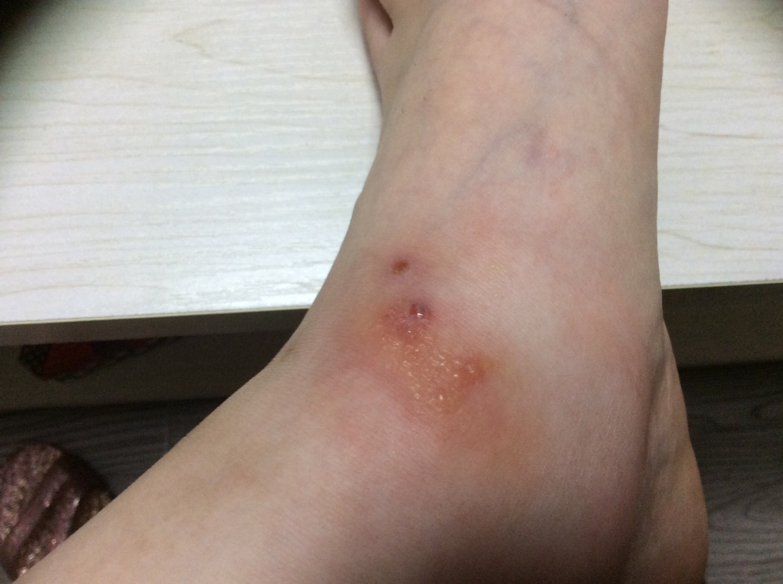 菁妈育儿|孩子被蜱虫咬，霸气爸爸的“三个坚决”救了娃，医生：做得好