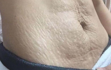 fashion美尚|怀孕后害怕身上长妊娠纹，注意这些要点，让妊娠纹离得远远的