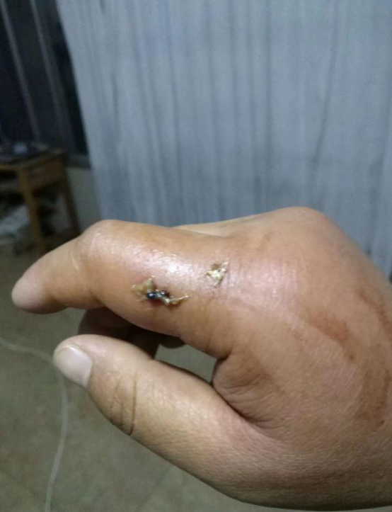 过敏反应|被马蜂蛰伤后请别慌，做好这5步，帮助处理伤口