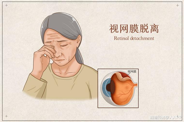 肝癌|眼部出现视网膜病变?一定要关注这种药物,长期使用会使视力丧失