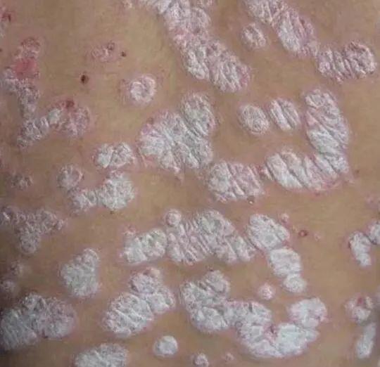 银屑病 牛皮癣为什么难治?万能的干细胞能否给牛皮癣患者带来希望?