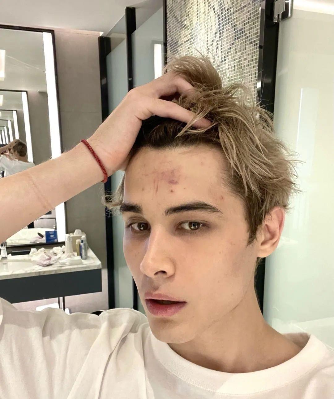 佟丽娅|刚开播就被打骨折了？国内综艺头一回