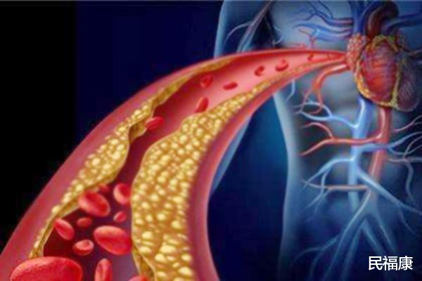 胆固醇|血脂高的人，饮食上要注意些什么？