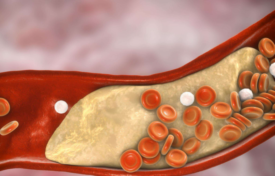 蔬菜|?肥肉是胆固醇的“催化剂”?不想血管“堵成石头”,少吃2种蔬菜