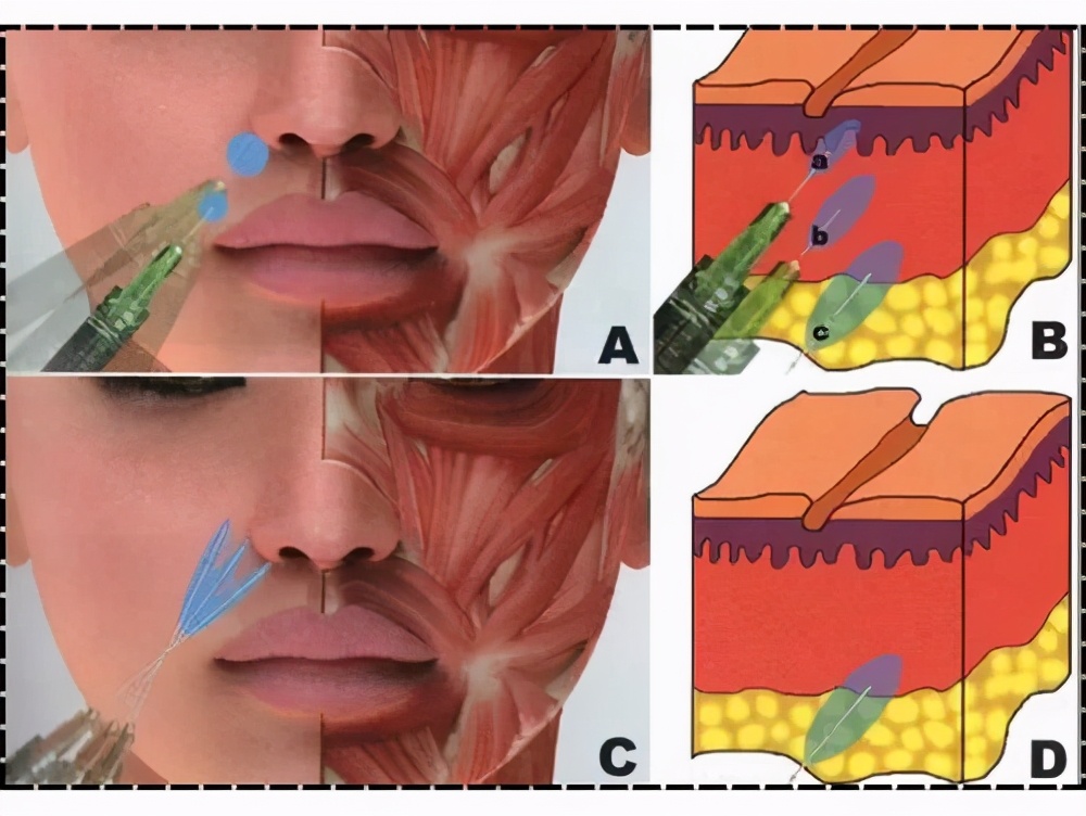 珑阳谈护肤 法令纹是如何形成的？怎么改善弱化法令纹？