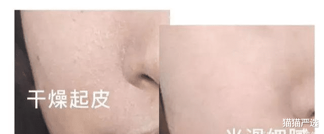 黑色素 还在走捷径打美容针？看看这些反面例子长点心吧！护肤这事急不得