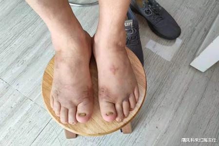 痛风科朱红梅主任 痛风为什么需要定期复诊？这几个痛风定期复诊的重要性你都知道了吗？