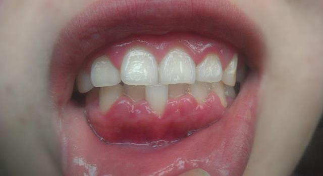 血糖|血糖偏高不能吃鸡蛋?医生提醒:若想稳定血糖,3种食物要少吃