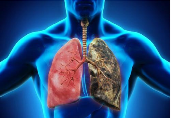 肾结石|呼吸科主任：保护肺部，清烟毒，常喝1水，尼古丁被清扫，肺部犹如“重生”