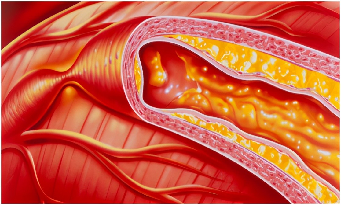 尿酸|尿酸超标，身体会发出2个信号提示，不想肾衰竭，2物敞开吃，降酸高手在民间