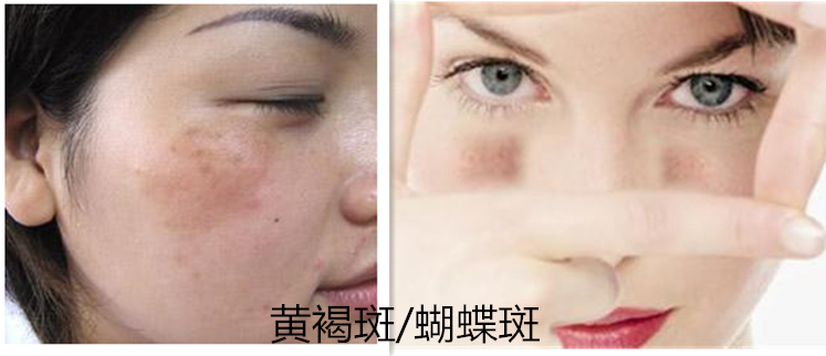 珑阳谈护肤 图解一分钟带你认清斑点分类，原来真的每个人都会长斑？