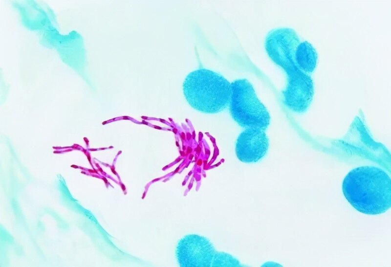 用户_胡洋|女病人被误认为结核差点被逼疯,其实是结核菌的“小兄弟”感染