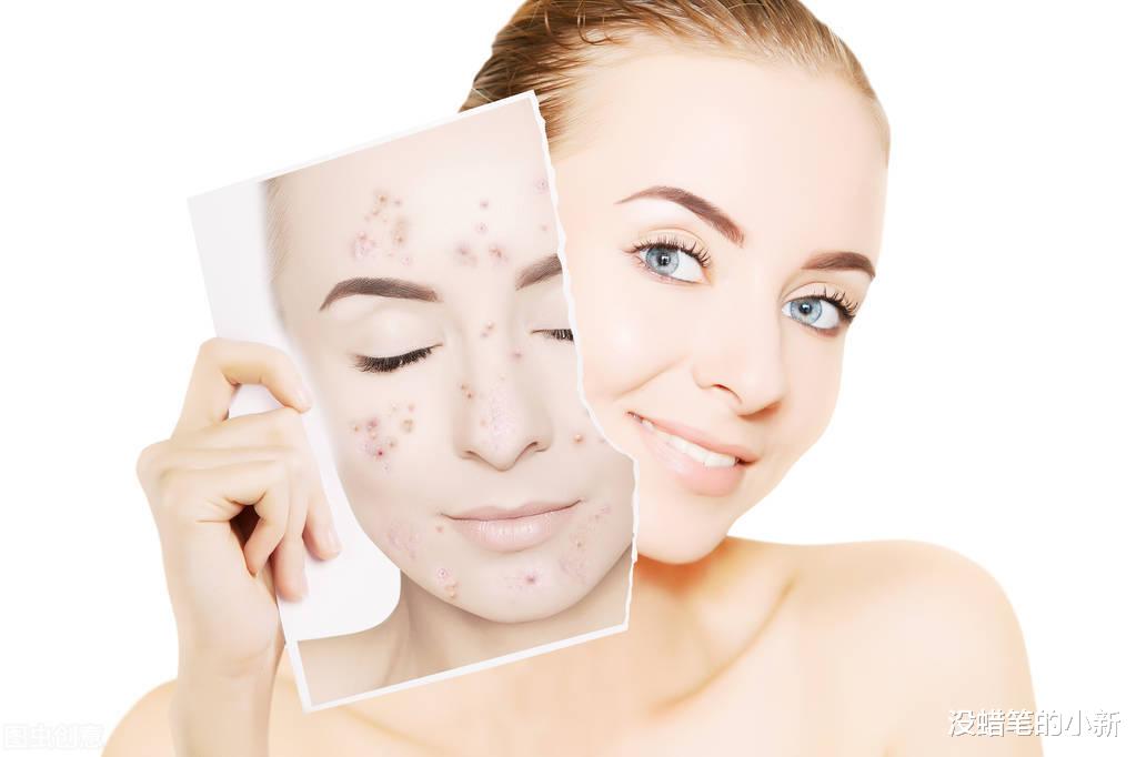 没蜡笔的小新|熬夜痘痘怎么快速消除？去掉痘痘的简单小妙招分享
