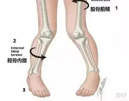 剪刀步|5种怪异步态，暗藏健康危机？