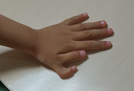 协和手足外科陈江海|宝宝多指应该什么时候做手术才是最佳时间?