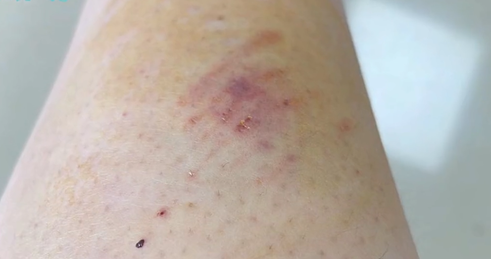 四面观察 女子被狗咬伤小腿,狗主人拒绝道歉协商:她的要求太离谱了