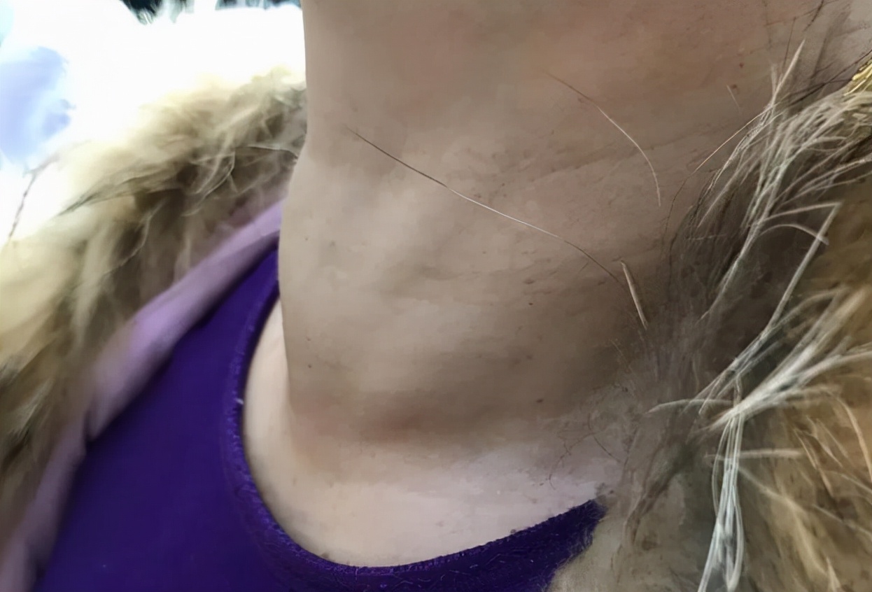 痛风|散结“冠军”被扒出，不是猕猴桃，医生：早晚各一次，养出婴儿甲状腺