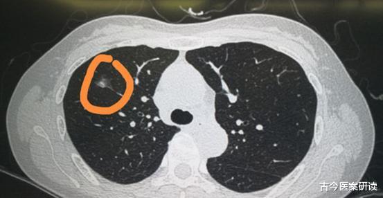 古今医案研读 肺结节恶化,身体检查时常有3个“异常”,若一个不占,恭喜!肺还算健康