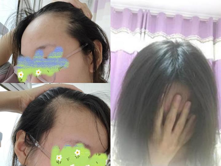 樱桃妈咪|拯救脱发大作战|秃头宝妈的救命宝典来了，真的不能再“脱”了！