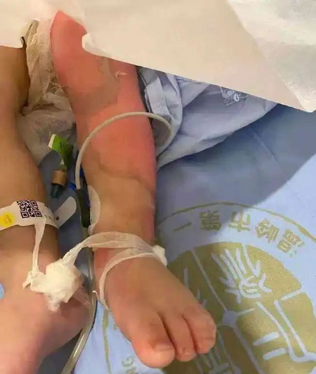 |烫伤急救不惊慌:牢记烫伤“五字经”,别随意听信偏方