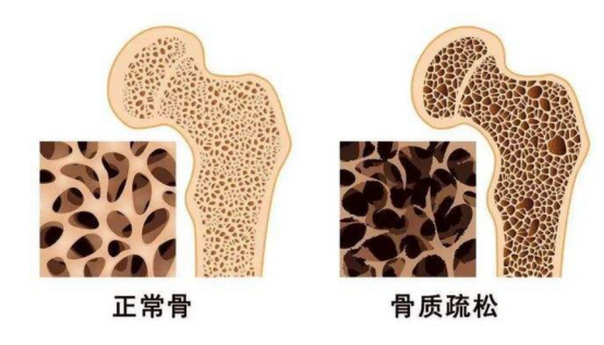 骨质疏松|骨质疏松不能吃鱼?医生:3种食物比鱼还“伤骨”,越吃骨头越松