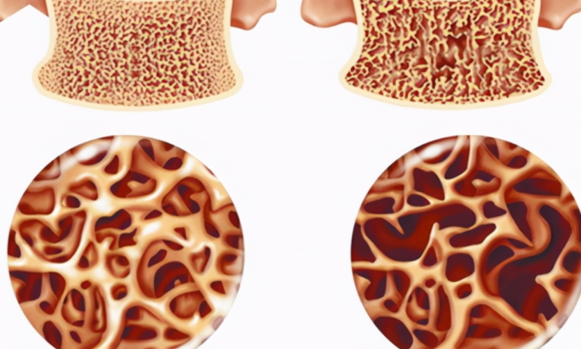 排毒|“伤骨王”已公布，这2物并列第一，医生提醒：想要骨骼健壮尽量少吃