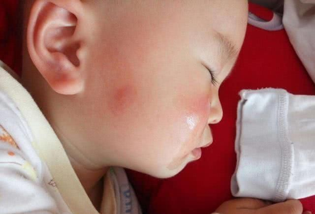 西红柿妈妈|孩子被咬后,若呈现这些状况代表不是蚊子咬的包,别自行处理