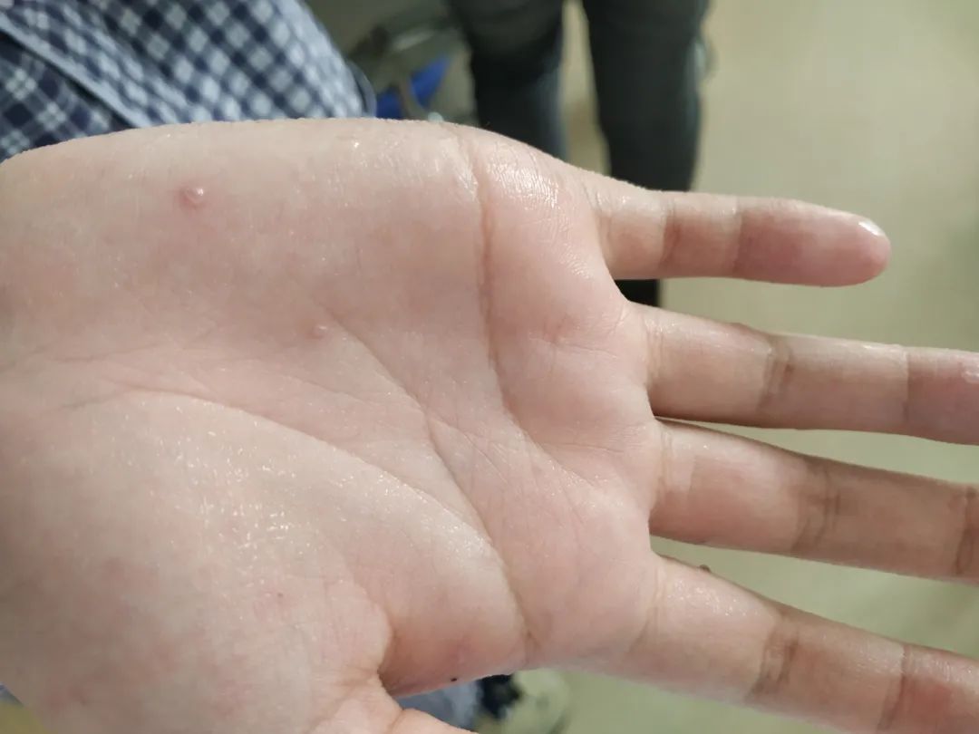 金兰中医学社|经常出汗是正常的吗？若是这7个地方频繁出汗，或是疾病作祟