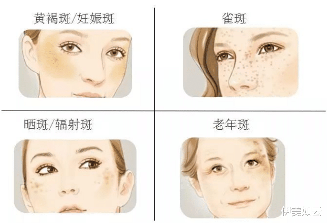 伊美如云|还在熬夜？小心出现斑中之王的“肝斑”