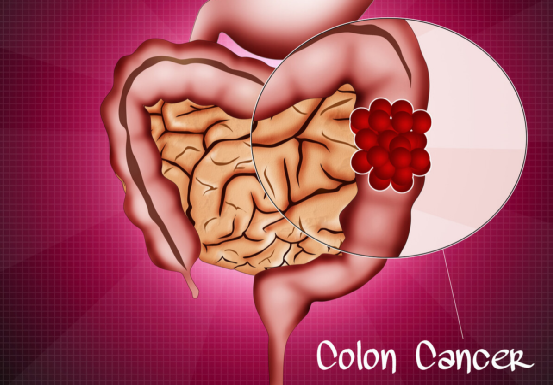 便秘|便秘患者注意：双腿若有3个异常，可能是肠癌找上门，及时检查