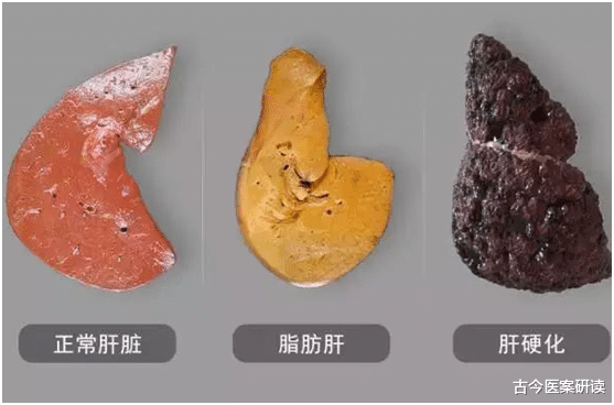 古今医案研读|肝上有癌，皮肤先知，皮肤若有3种“异常”，八成是肝病“信号”